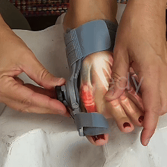 Adjust bunion corrector tension