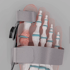 BunionFix product structure and toe alignment support