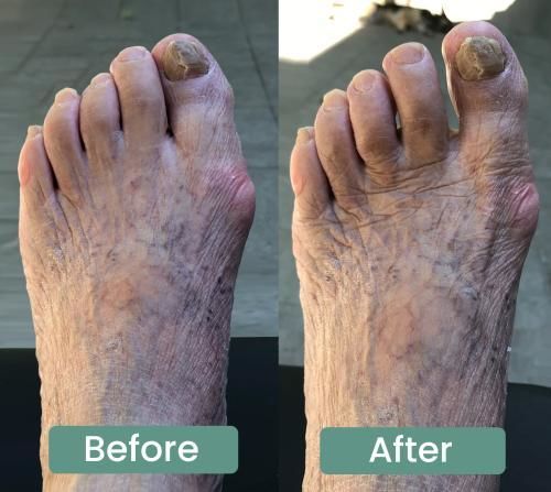 Customer bunion before and after comparison photo