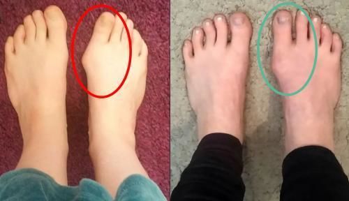 Customer foot photo using bunion support